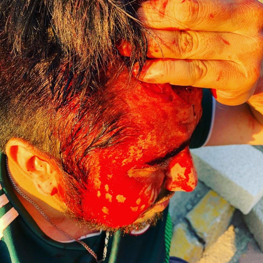 TRABAJADORES DEL AYUNTAMIENTO DE TZOMPANTEPEC AGREDEN A MIEMBRO DE COMITÉ DE SEGURIDAD DEL FRACCIONAMIENTO BASES&nbsp;MAGISTERIALES